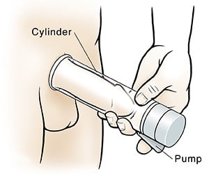 Penis Pump Demonstration Illustration